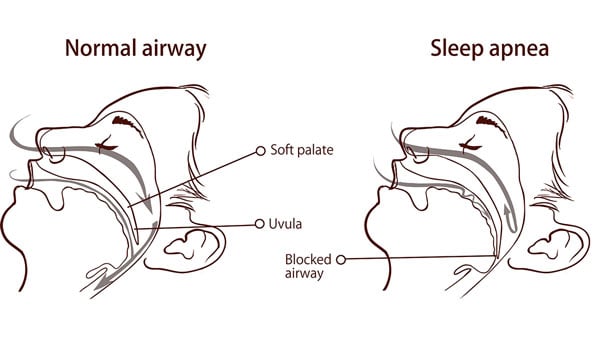 SLEEP AP diagram-of-a-woman-sleeping-with--and-without-sleep-apnea