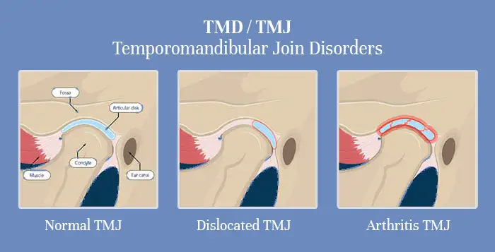 TMD / TMJ Disorders